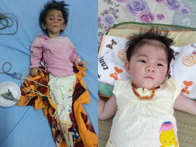 Tin tức trong ngày - Bé 14 tháng nặng 3,5 kg được "người mẹ 9X" nuôi giờ ra sao?