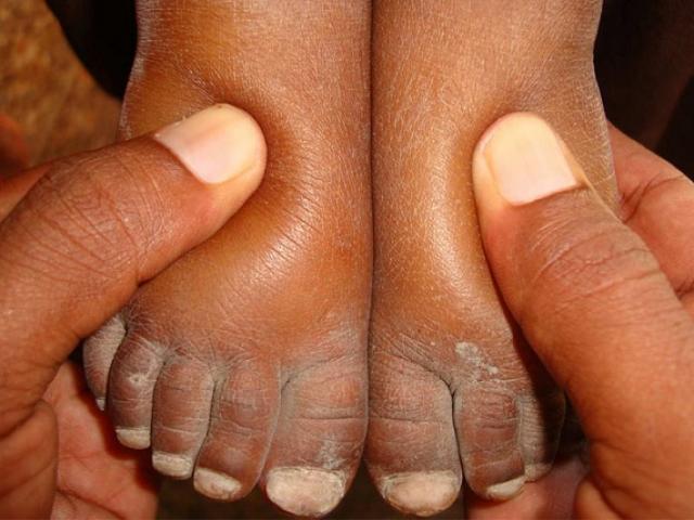 Sức khỏe đời sống - Đừng để “chết oan” vì bỏ qua dấu hiệu phù