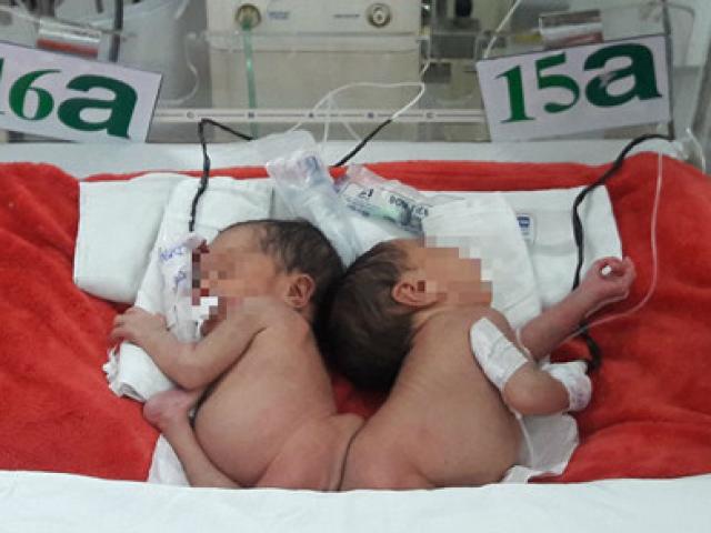 Sức khỏe đời sống - Hai bé song sinh dính mông: Sau phẫu thuật sẽ thế nào?