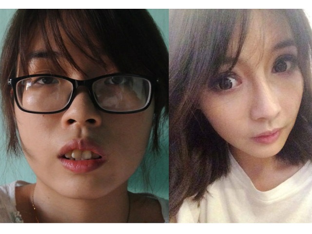 Thẩm mỹ viện - 9X hàm hô "lột xác" hoàn toàn sau 3 tháng