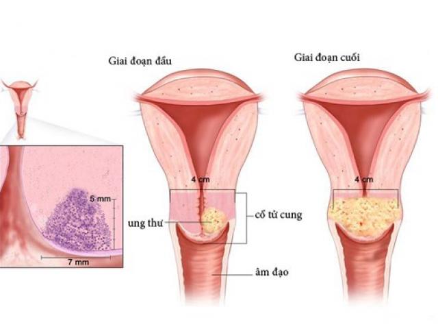 Sức khỏe đời sống - Chuyên gia đầu ngành chia sẻ 4 bước phát hiện sớm ung thư cổ tử cung
