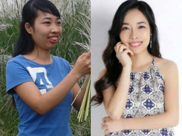 Thẩm mỹ viện - "Đá bay" hàm hô, cô gái Phú Thọ cười quá duyên