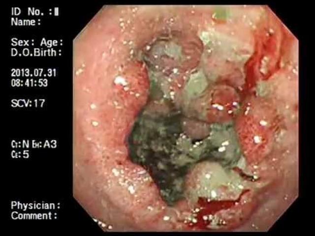 Sức khỏe đời sống - Bố mẹ sốc vì bé 5 tuổi suýt bị ung thư vì lây từ ông ngoại