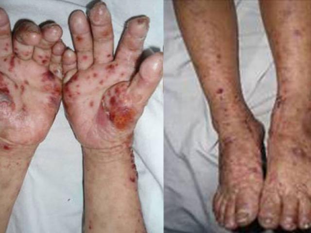 Sức khỏe đời sống - Khám, sàng lọc miễn phí cho người dân mắc 'bệnh lạ'