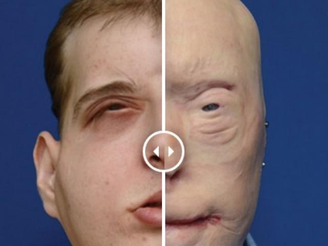 Thế giới - Người đầu tiên được ghép mặt người khác giờ ra sao?