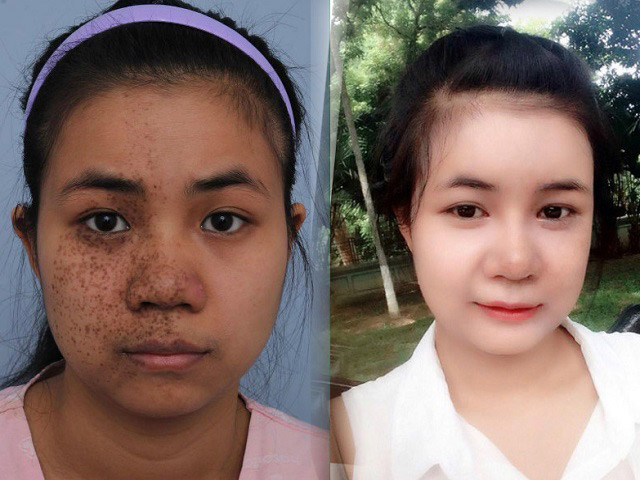 Thẩm mỹ viện - 9X bị đốm đen xì nửa mặt "lột xác" quá khác lạ