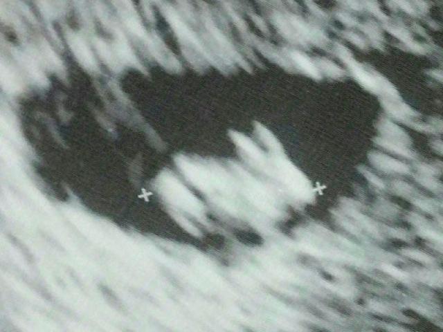 Mẹ bầu 7 tuần siêu âm thấy “thỏ con” trong bụng
