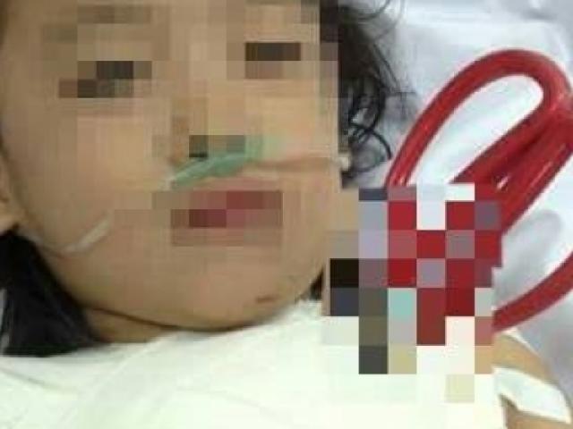 Sức khỏe đời sống - Cấp cứu kịp thời bé gái bị kéo đâm xuyên ngực