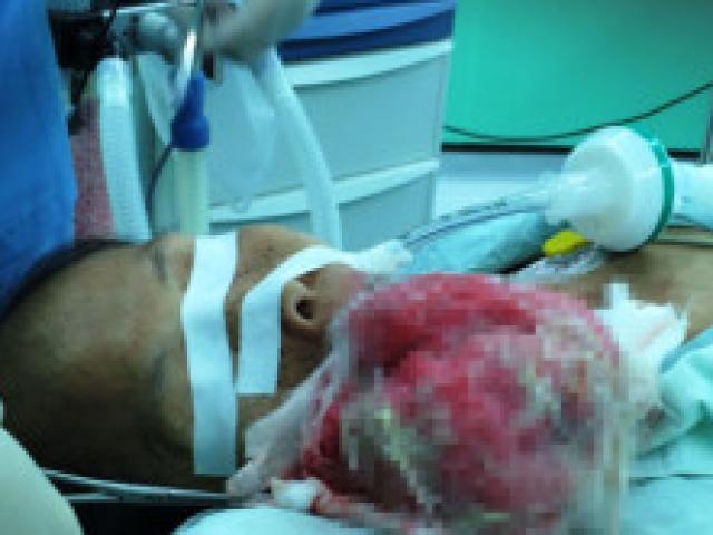 Sức khỏe đời sống - Cắt khối u hơn 1 kg trên mặt bệnh nhân 53 tuổi