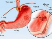 Sức khỏe đời sống - Infographic: 8 món ăn người bị viêm dạ dày cần tránh xa