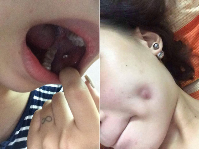 Bạn trẻ - Cuộc sống - Nữ sinh lớp 12 thủng mặt vì làm lúm đồng tiền giả