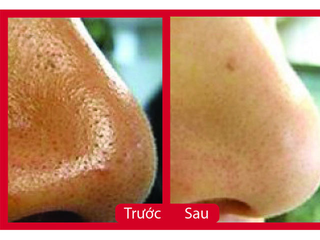 Tư vấn làm đẹp - Tẩy sạch mụn đầu đen mũi bằng kem đánh răng