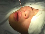 Cảnh giác với nâng mũi không cần dao kéo