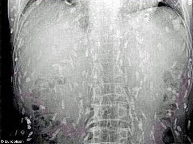 Phi thường - kỳ quặc - Chỗ nào cũng ngứa, vào viện mới biết con vật này len lỏi khắp cơ thể