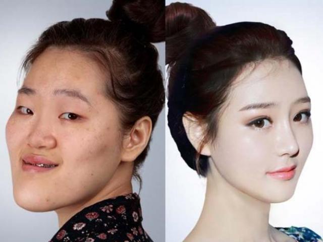 Thẩm mỹ viện - Sau 60 ngày, cô gái hàm "bồ nông" bỗng xinh như tiên nữ