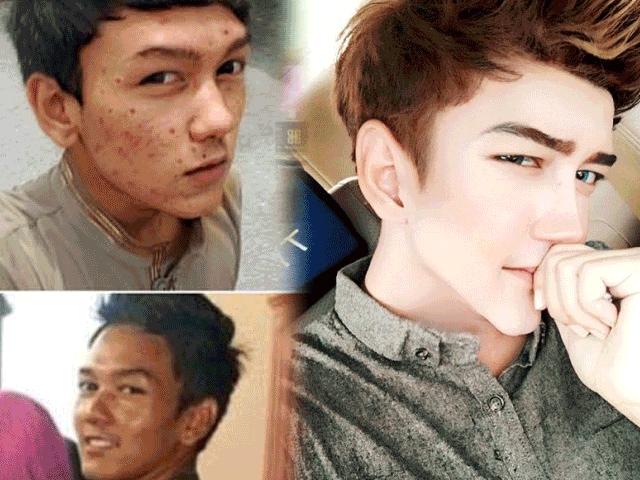 Sốc vì mặt mụn chi chít trước "dao kéo" của hot boy Malaysia