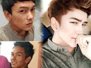 Bí quyết làm đẹp - Sốc vì mặt mụn chi chít trước &quot;dao kéo&quot; của hot boy Malaysia