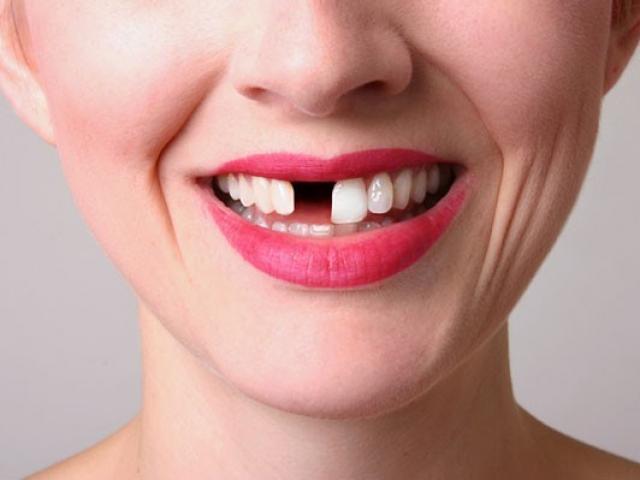 Pháp luật - Bị gãy 1 răng, được bồi thường 56 triệu đồng