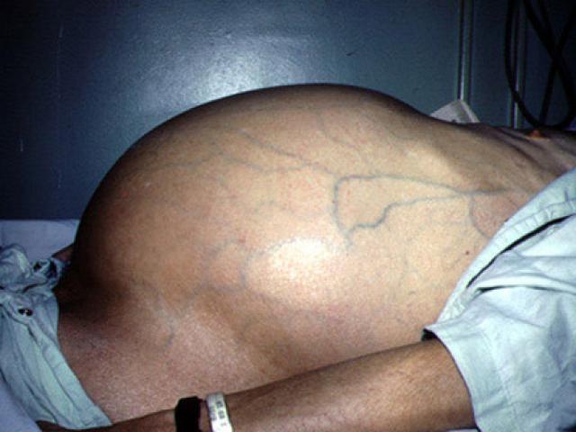 Sức khỏe đời sống - Cạo râu, xâu khuyên, xăm mình liên quan đến căn bệnh ung thư top đầu thế giới