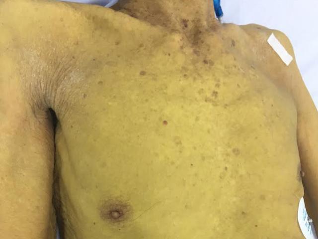 Sức khỏe đời sống - Người vàng ệch như củ nghệ vì thói quen nhà nào cũng mắc