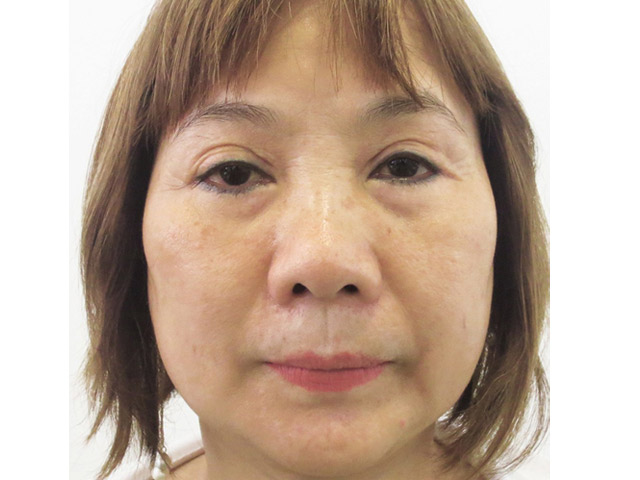 Thẩm mỹ viện - Hoảng hốt với những đôi mắt trợn trừng, lờ đờ vì phẫu thuật hỏng