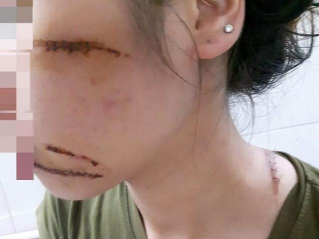 Pháp luật - Nữ nhân viên spa bị nhóm côn đồ chém trọng thương