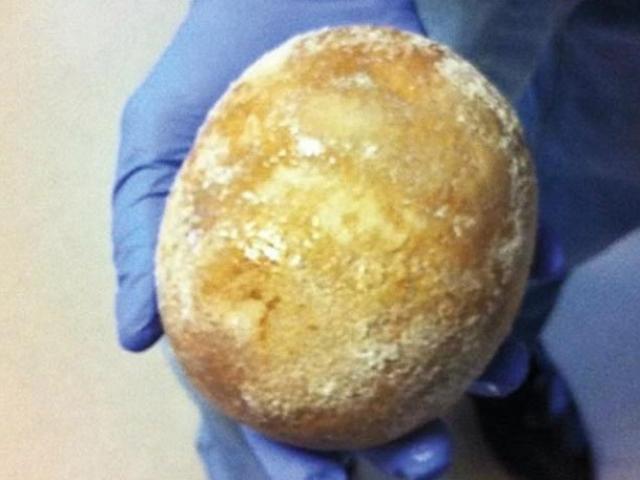 Sức khỏe đời sống - Viên sỏi bàng quang ‘khủng’ to như trứng đà điểu