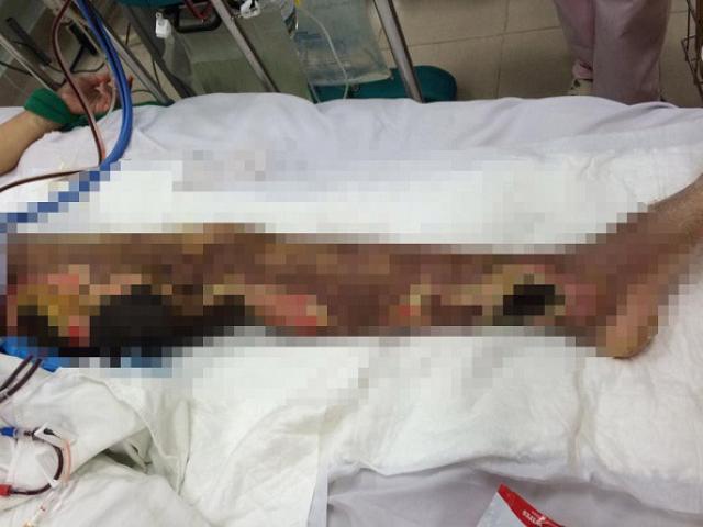 Sức khỏe đời sống - Chân hoại tử bốc mùi hôi thối vì tin "bác sĩ google" hơn bác sĩ thật