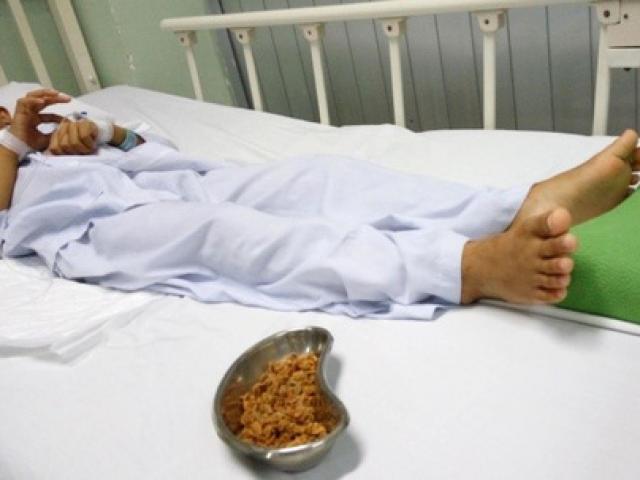 Sức khỏe đời sống - Lấy hơn 70 gram hạt sơ-ri nảy mầm trong hậu môn bé trai