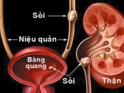 Sức khỏe đời sống - Bài thuốc phòng trị sỏi thận, tiết niệu