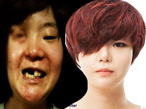 Thẩm mỹ viện - Cô gái mất nửa mặt tìm lại nhan sắc nhờ dao kéo