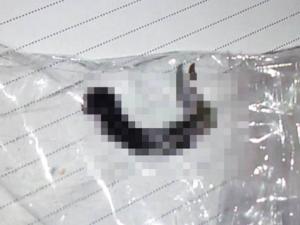 Sức khỏe đời sống - Gắp thành công đỉa sống hơn 1 tháng trong thanh quản bé 11 tuổi