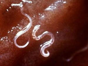 Sức khỏe đời sống - Nhiễm giun đũa chó: Cắt một phần gan vì chẩn đoán nhầm là khối u