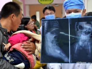 Tin tức trong ngày - TQ: Bé gái bị đâm 12 chiếc kim khâu vào người