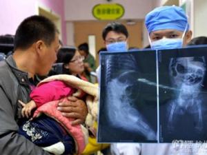 Phi thường - kỳ quặc - Hốt hoảng phát hiện 12 chiếc kim trong cơ thể bé gái