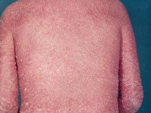 Sức khỏe đời sống - Mất con gái cưng, bố đột ngột mắc bệnh "lột da rắn"