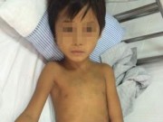 Sức khỏe đời sống - Bé trai nguy kịch vì nhiễm xoắn khuẩn vàng da từ động vật