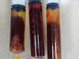 An toàn thực phẩm - Ăn thịt bò tái, bé gái 4 tuổi bị nhiễm sán lá gan