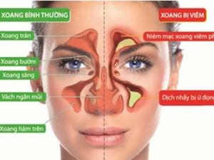 Sức khỏe đời sống - Mẹo xử lý khi bị tắc nghẹt mũi