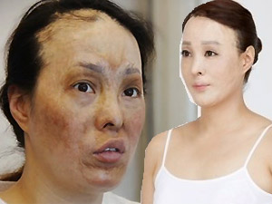 Thẩm mỹ viện - 2 bà mẹ có gương mặt bị hủy hoại tìm lại nhan sắc