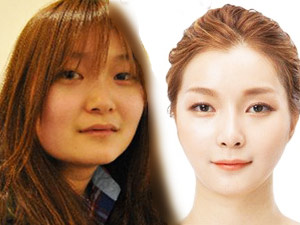 Thẩm mỹ viện - Cô gái mặt vuông xinh như búp bê sau khi "gọt cằm"