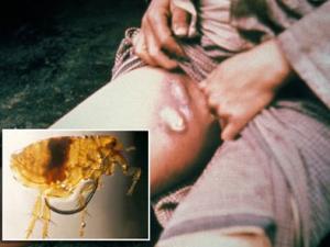 Sức khỏe đời sống - Bệnh dịch hạch biểu hiện trên người như thế nào?