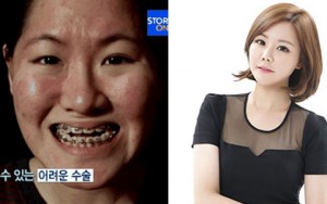 Thẩm mỹ viện - Hàm bạnh, mắt hí bất ngờ hóa hot girl xinh đẹp