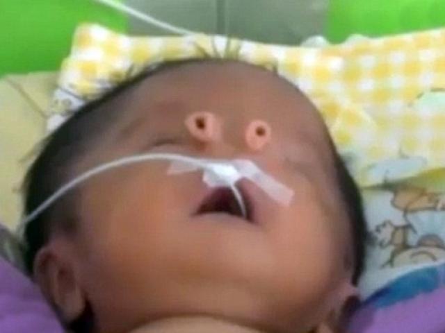 Video: Cậu bé không có mũi chào đời ở Peru