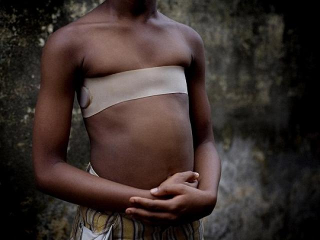 Phi thường - kỳ quặc - Tục lệ lạ: Dùng đá nóng để là phẳng ngực thiếu nữ mới lớn