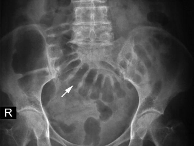 Bệnh trẻ em - Tắc ruột non vì khối hạt ổi to 10 cm