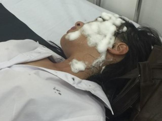 Pháp luật - Mâu thuẫn tình cảm, hai nữ sinh bị tạt axit bỏng nặng?