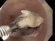 Suýt tử vong vì xương cá ngát làm thủng thực quản