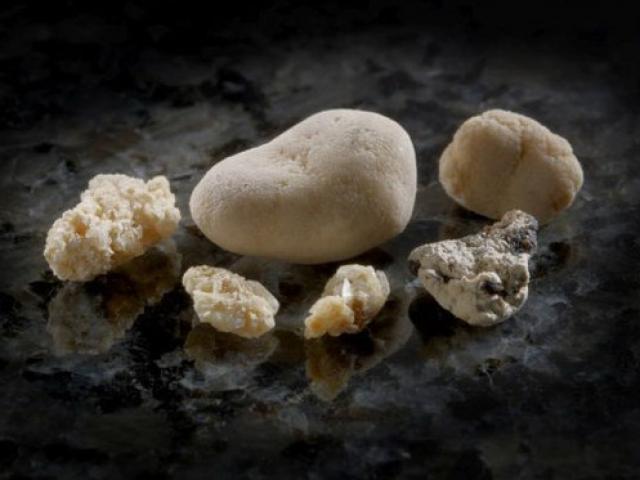 Sức khỏe đời sống - Bổ sung canxi, tăng nguy cơ sỏi thận