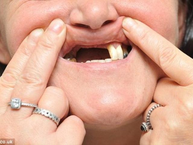 Sức khỏe đời sống - Mất hàm răng cửa vì tẩy trắng răng ở nha sĩ "dởm"